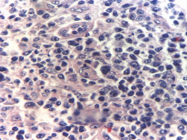 Fig.6: TCRBCL. H-E - <div style=
